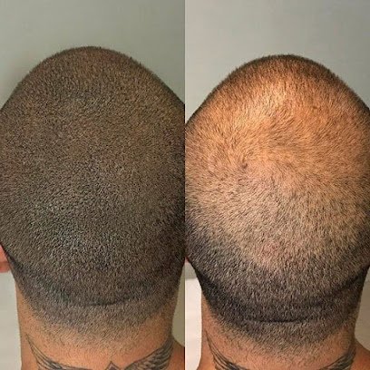 Glamorous Hair Transplant