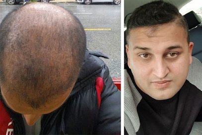 Dr Abdul Khaliq'S Hair Transplant