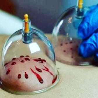The Prime Hijama Center