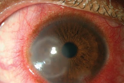 Hussain Eye Care