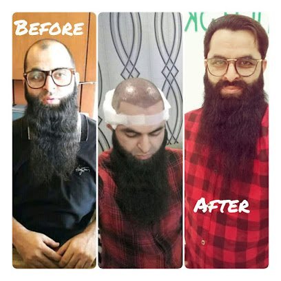 Hair Transplant (Fue)