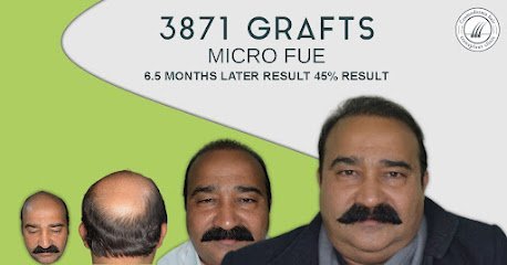 Hair Transplant Clinic Lahore