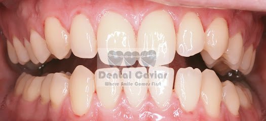 Dental Caviar
