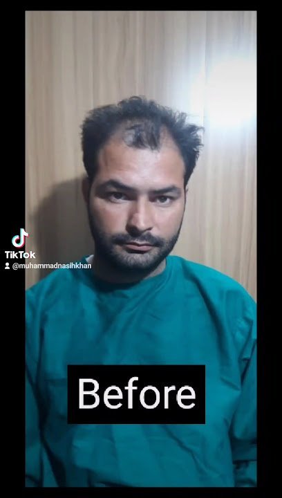 K-Royal Hair Transplant
